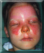 Thermischer Verletzung durch heißes Öl Thermal injuries caused by hot oil Thermique à l’huile bouillante